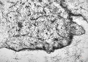 F,80y. | leiomyosarcoma - thigh